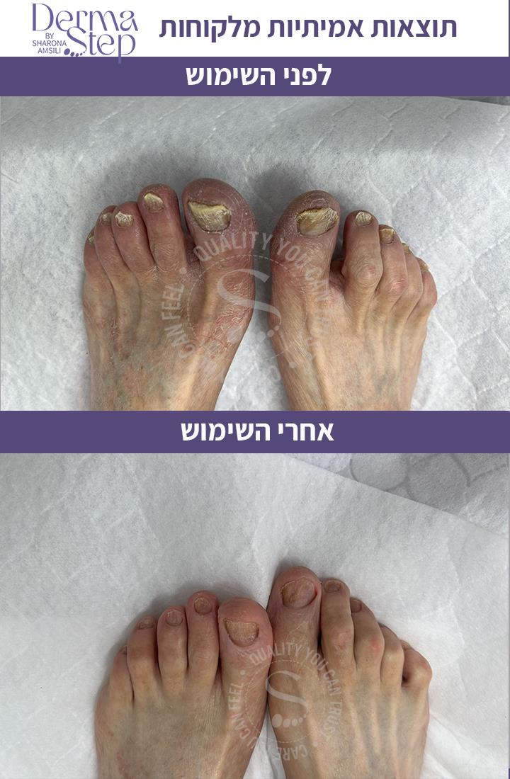 טיפות לטיפול , שיקום וחידוש צמיחה של הציפורן