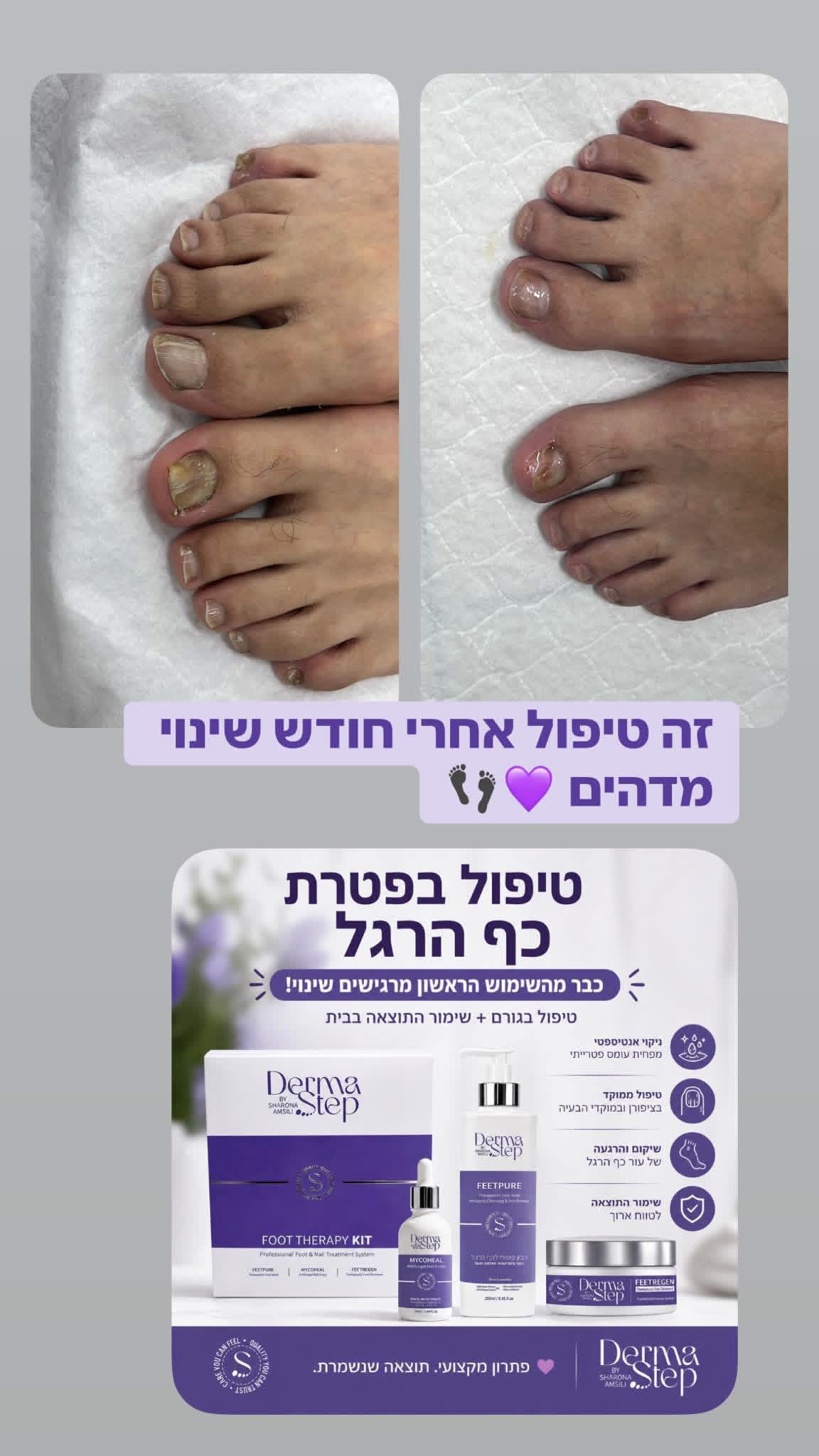ערכה לטיפול בפטרת כף הרגל והציפורניים