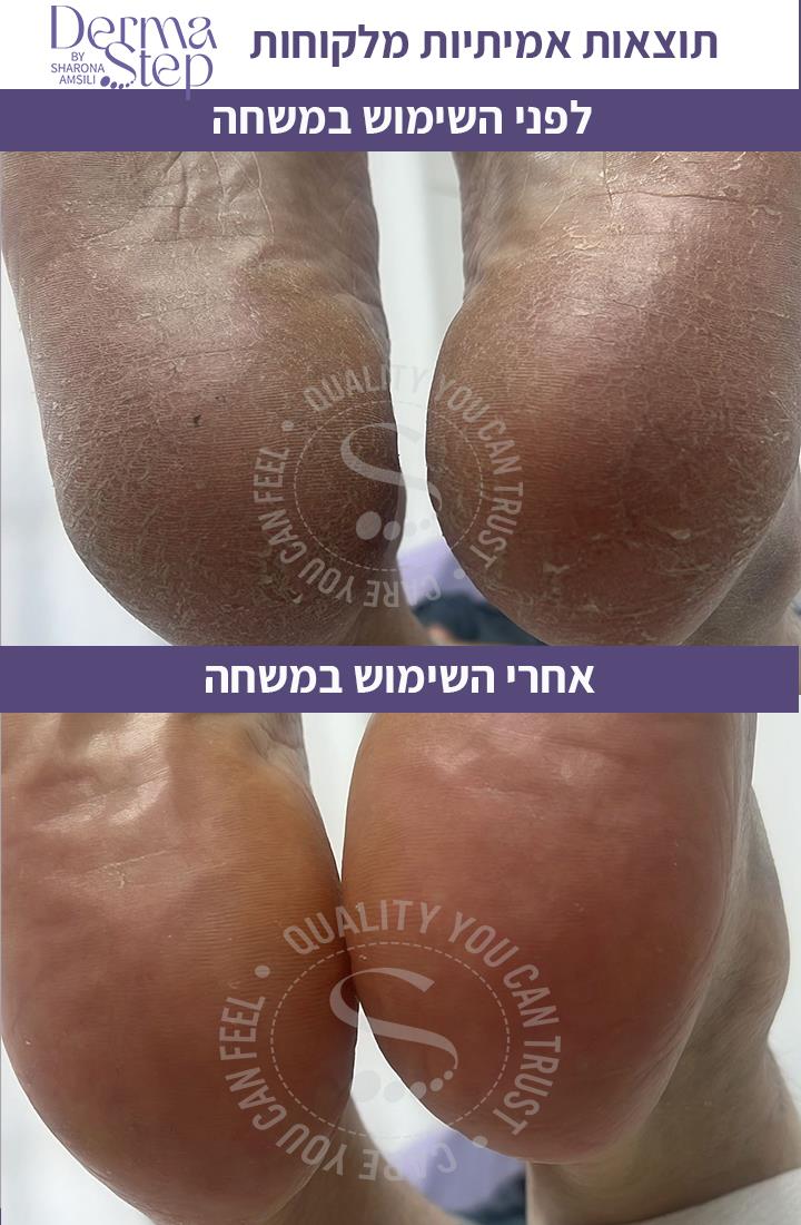 משחה טיפולית לכף הרגל לטיפול מקיף בעור נוטה לפטרת