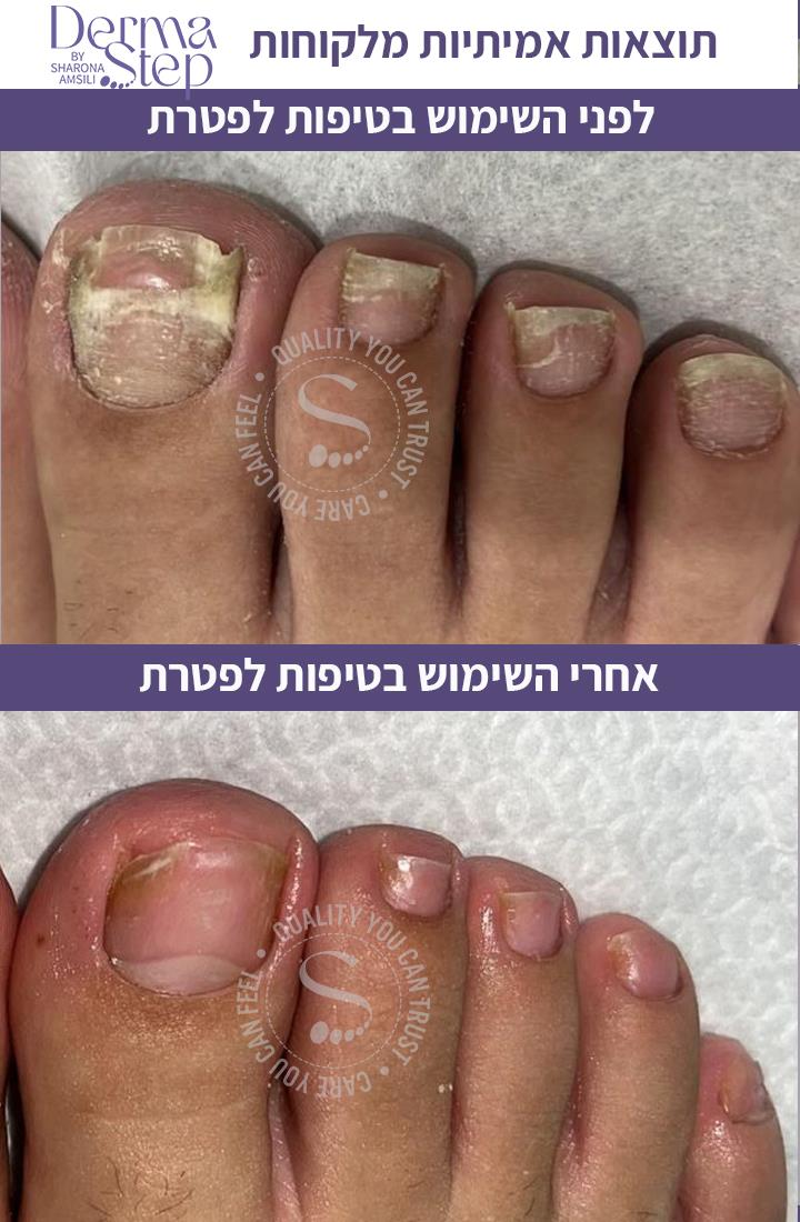 טיפות לטיפול בפטרת, שיקום וחידוש של הציפורן