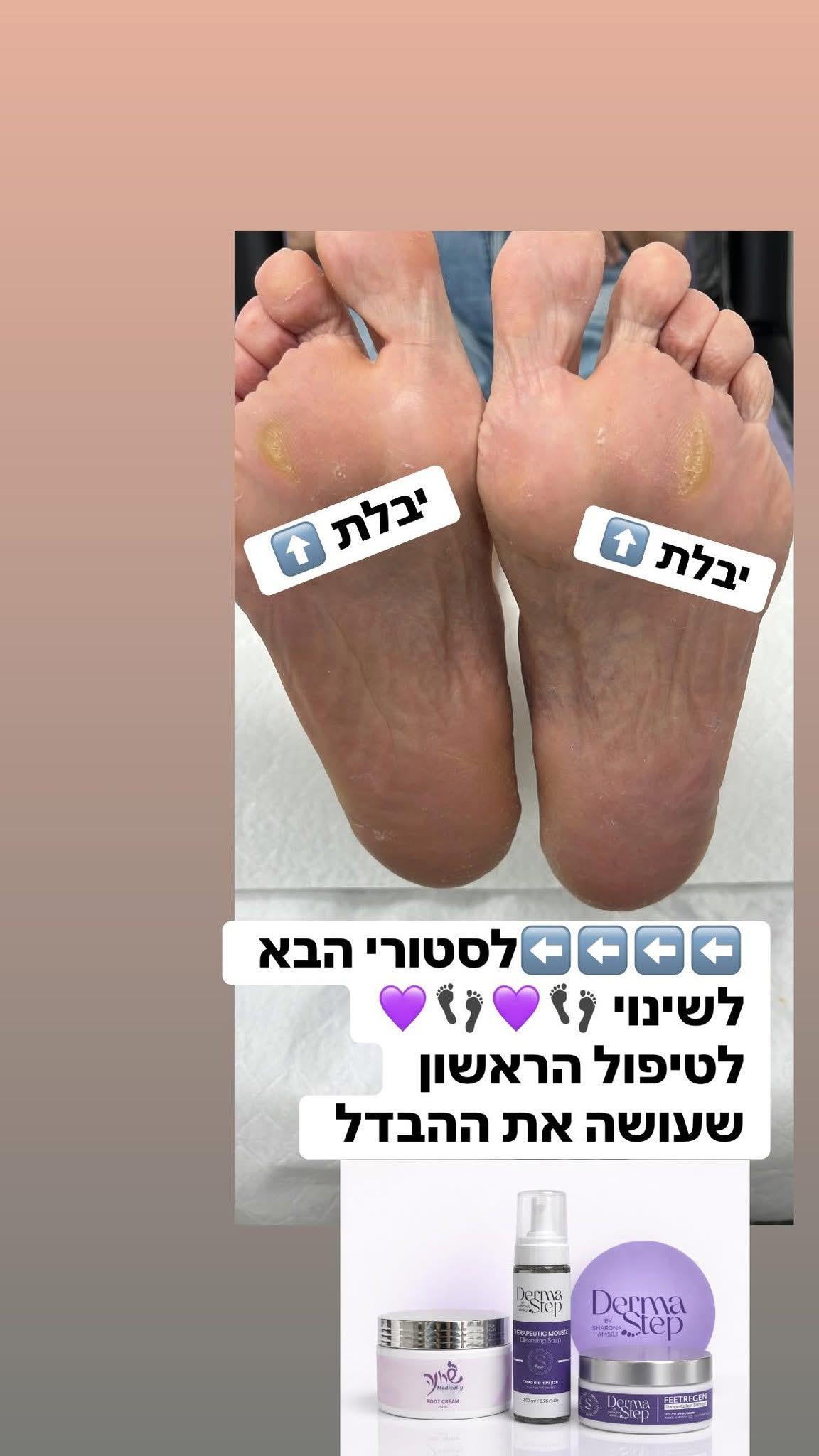 משחה טיפולית לכף הרגל לטיפול מקיף בעור נוטה לפטרת