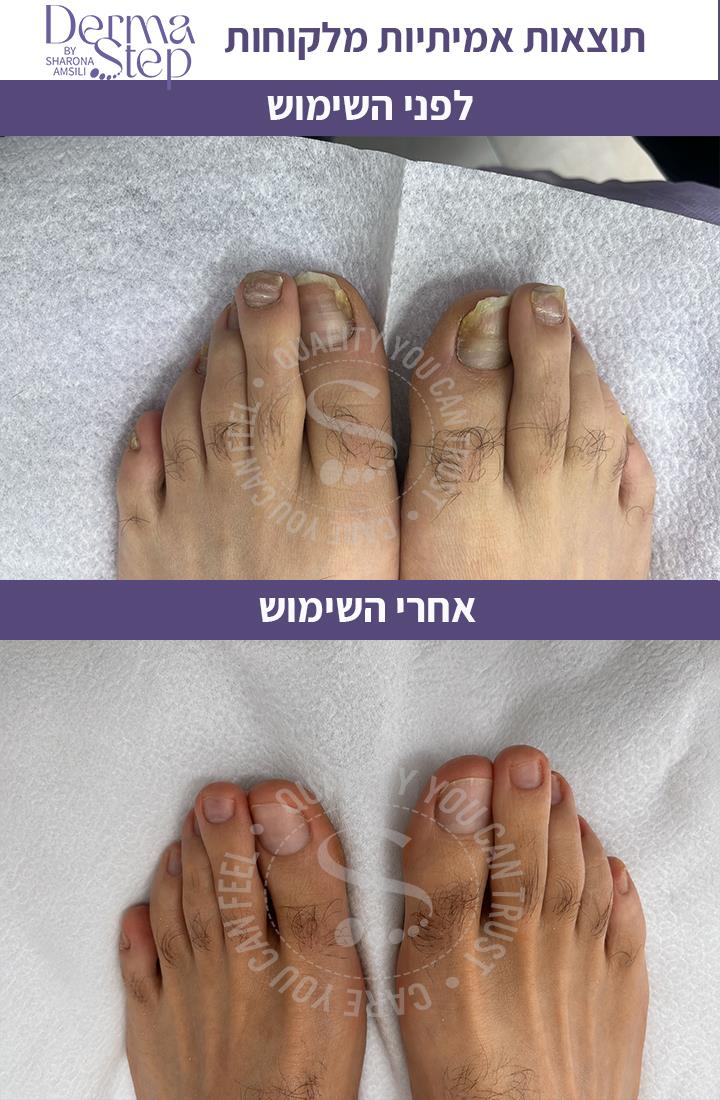 טיפות לטיפול , שיקום וחידוש צמיחה של הציפורן
