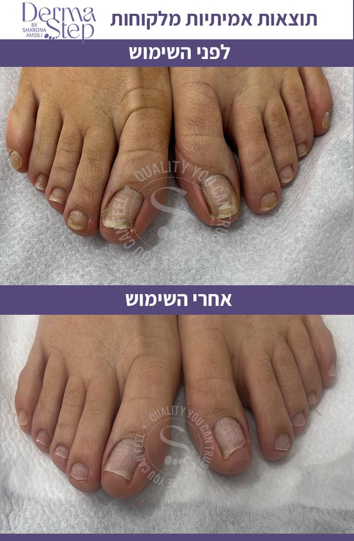 טיפות לטיפול , שיקום וחידוש צמיחה של הציפורן