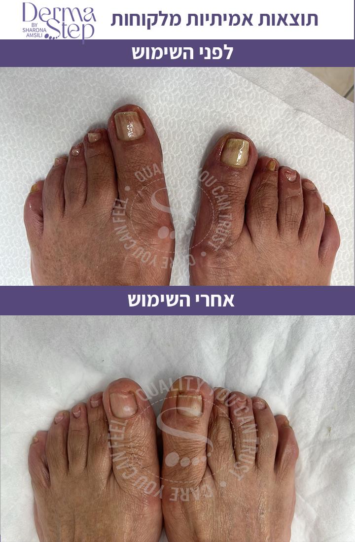 טיפות לטיפול , שיקום וחידוש צמיחה של הציפורן