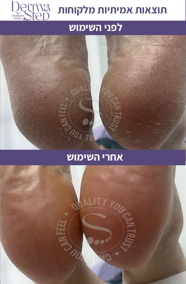 סבון טיפולי לכף הרגל-ניקוי וחידוש העור