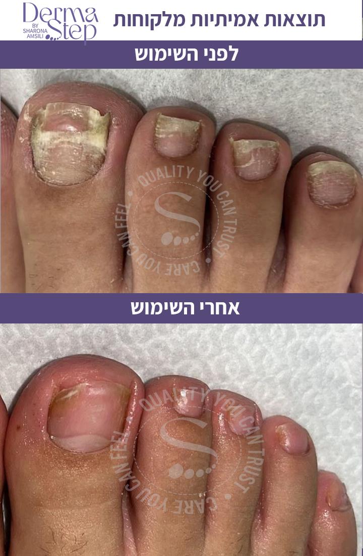 סבון טיפולי לכף הרגל-ניקוי וחידוש העור