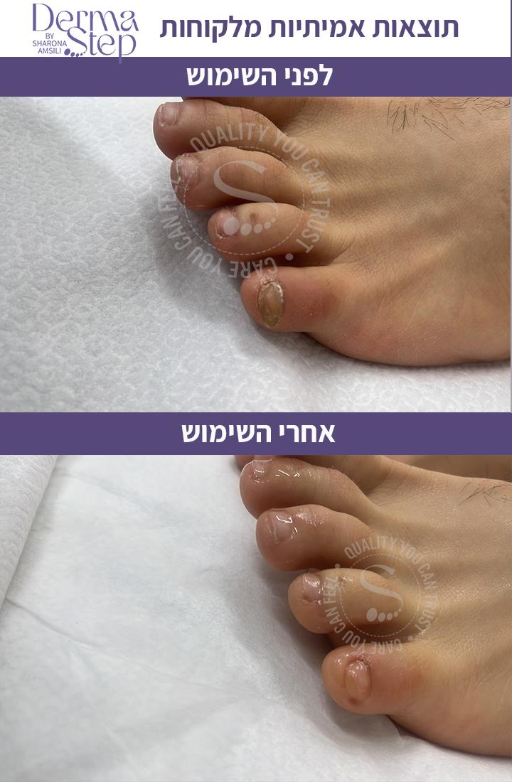 טיפות לטיפול , שיקום וחידוש צמיחה של הציפורן
