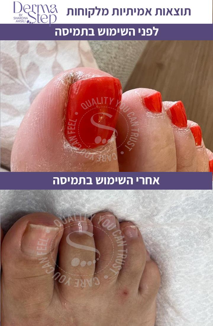 תמיסה לריכוך הציפורן ולשיקום העור