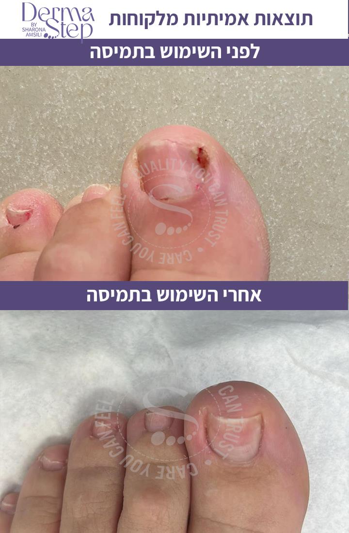 תמיסה לריכוך הציפורן ולשיקום העור