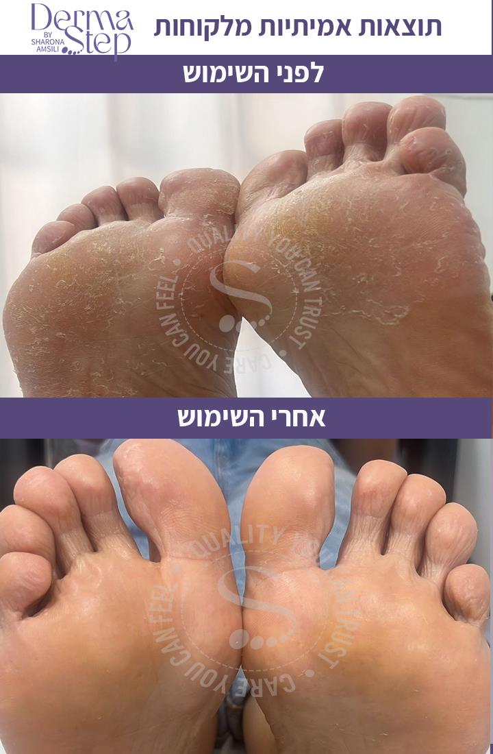 סבון טיפולי לכף הרגל-ניקוי וחידוש העור
