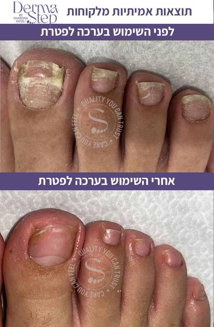 ערכה לטיפול בפטרת כף הרגל והציפורניים