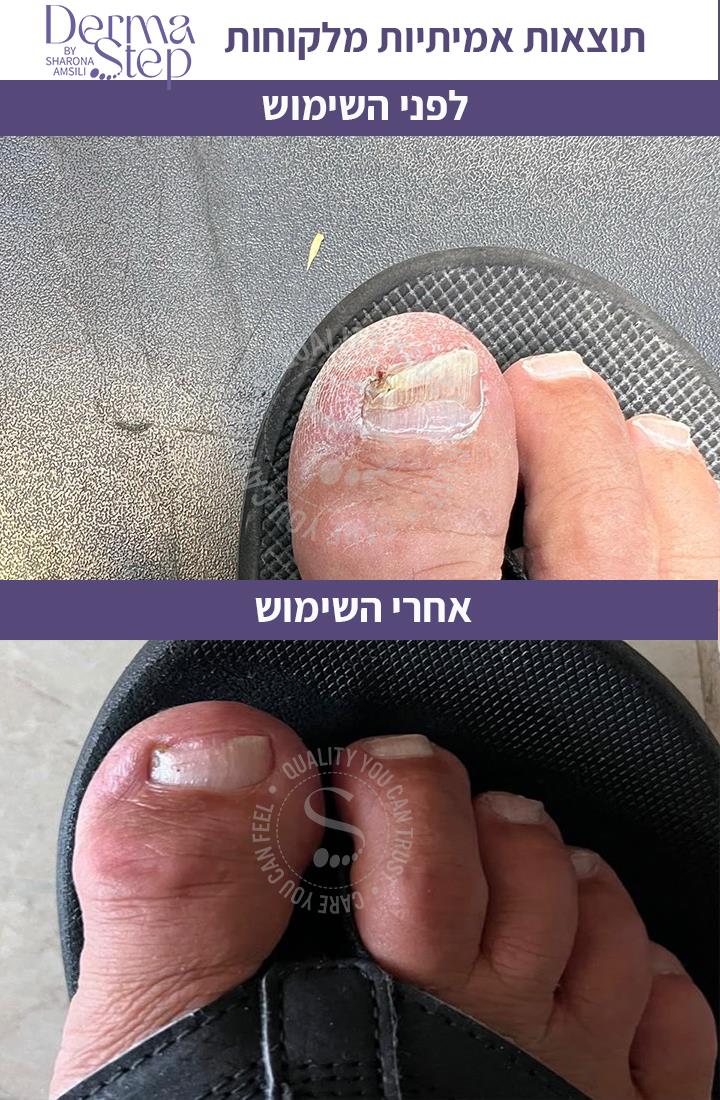 טיפות לטיפול , שיקום וחידוש צמיחה של הציפורן