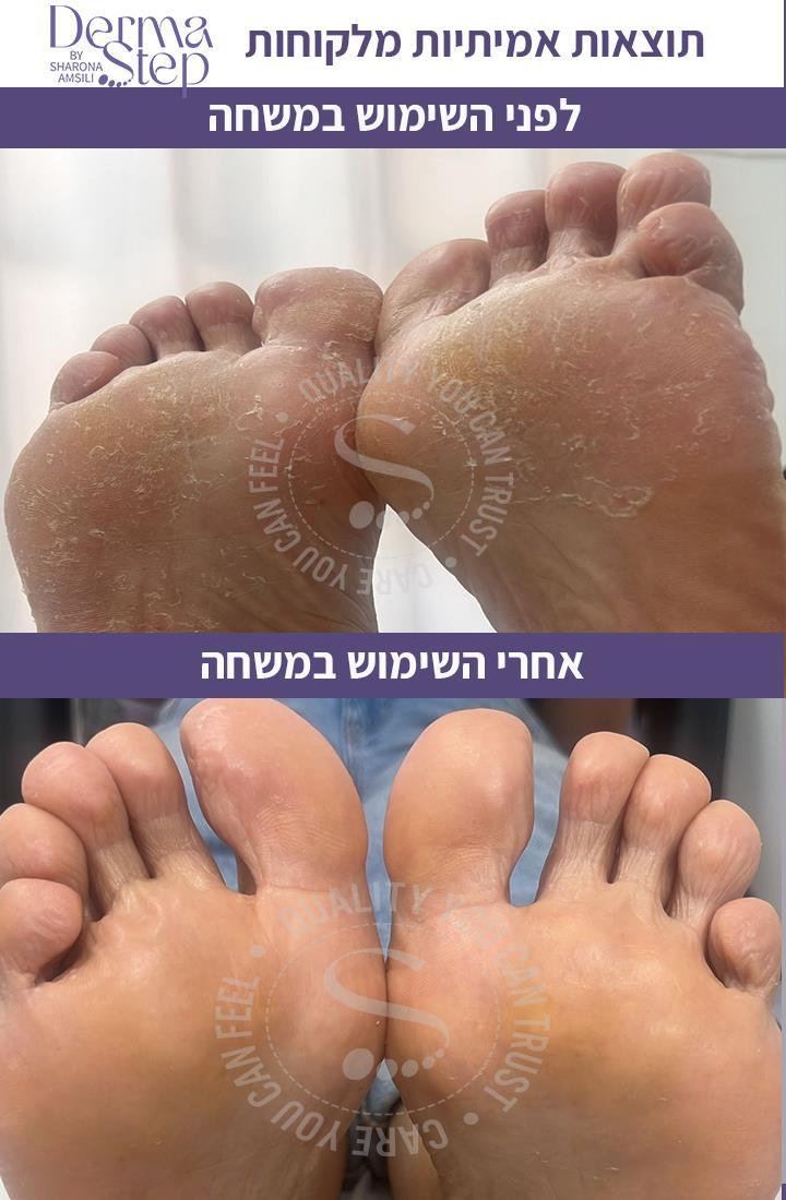 משחה טיפולית לכף הרגל לטיפול מקיף בעור נוטה לפטרת